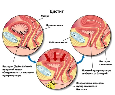 УРЕАПЛАЗМА У ЖЕНЩИН: ПОСЛЕДСТВИЯ, СИМПТОМЫ, ЛЕЧЕНИЕ. | Надежда | Дзен