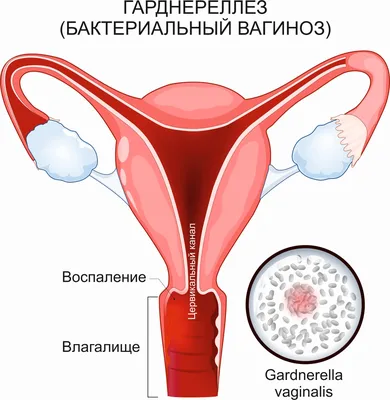 Уреаплазмоз. Лечение уреаплазмоза доклад по медицине | Упражнения и задачи  Медицина | Docsity