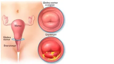 Уреаплазмоз у женщин: что это за заболевание и как его лечить