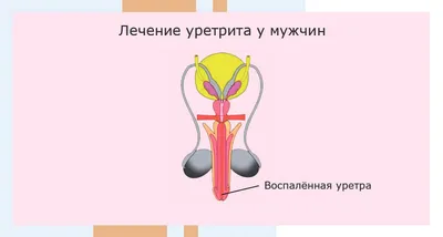 Уретрит у мужчин симптомы и лечение в клинике АльтраВита в Москве