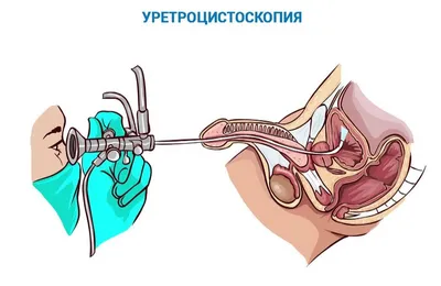 Уретрит, симптомы и признаки. Лечение уретрита у мужчин и у женщин.