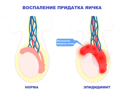 Уретрит - причины появления, симптомы заболевания, диагностика и способы  лечения