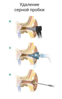 Серная пробка в ухе: как убрать, симптомы, как выглядит ушная серная пробка,  признаки