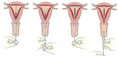 Гинеколог - 1️⃣Миф первый. Спираль увеличивает риск образования внематочной  беременности. ✓Правда. Но следует учитывать тот фактор, что существует два  вида спиралей: металлические и гормоносодержащие. Применение медных спиралей  может вызвать ...
