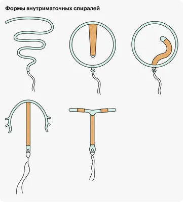 Внутриматочная спираль, плюсы и минусы. | Мария Филатова | Дзен