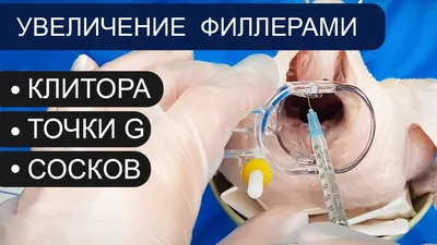 Увеличение губ до и после | Губы, Ботокс губы, Увеличение губ