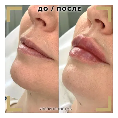 Увеличение губ | Цены процедуры | Telos Beauty