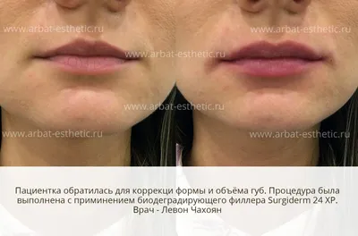 Гиалуроновая кислота Juvederm Ultra 3 - «Фото-дневник первого увеличения губ:  ощущения и результаты по дням! Стоит ли оно того? Ассиметрия губ. Фото ДО,  ПОСЛЕ, спустя 5 месяцев.» | отзывы