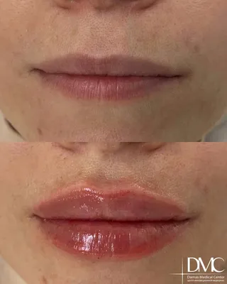 Увеличение губ Juvederm (Ювидерм) в Москве, цена за 1 мл от 26000 руб.