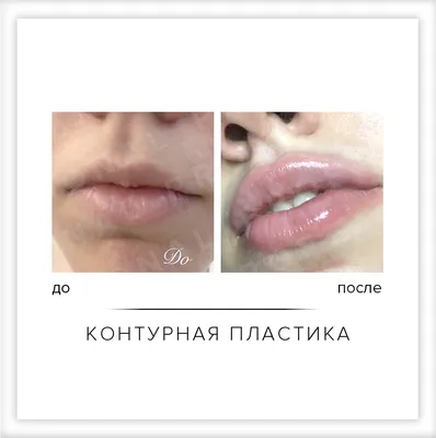 Увеличение губ гиалуроновой кислотой - VIP Clinic. Коррекция объема,  контура, тонких, маленьких губ филлером Belotero, Juvederm. Цена 1 мл