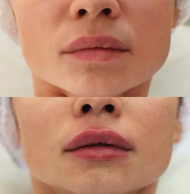 Увеличение губ препаратом Juvederm Ultra 3 (1 мл) в AvenueMedSpa