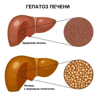 Жировая болезнь печени часто встречается у людей с ВИЧ - Life4me+