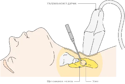 Как лечить щитовидную железу: виды заболеваний и симптомы