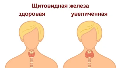 Аутоиммунный тиреоидит щитовидной железы (АИТ): лечение, симптомы и  признаки, причины возникновения