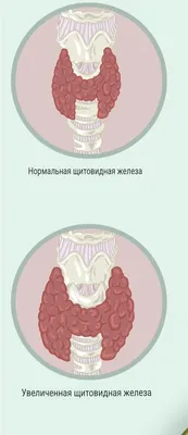 Зоб - \"АГАПЕ\" Медицинский центр в Люблино