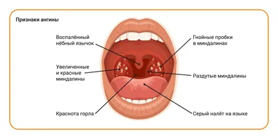 Гнойная ангина, чем лечить гнойную ангину, симптомы и признаки - блог  Furasol®