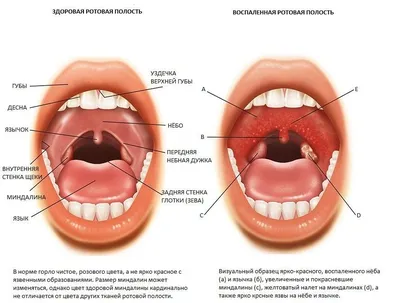Увеличенные аденоиды и аденоидит – в чем разница и почему возникают:  отвечает врач-педиатр | О детском здоровье: с врачебного на родительский |  Дзен