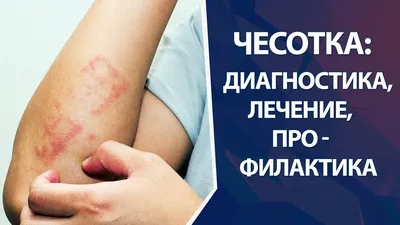 Контагиозный моллюск: симптомы, диагностика и лечение в клинике Universum  Clinic