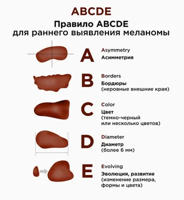 Меланома кожи с поражением центральной нервной системы