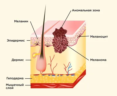 Беспигментная узловая меланома кожи голени – тема научной статьи по  клинической медицине читайте бесплатно текст научно-исследовательской  работы в электронной библиотеке КиберЛенинка