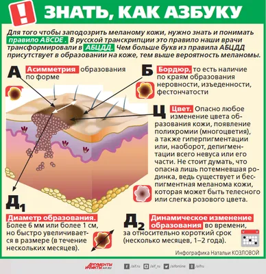 Врага надо знать в лицо. В ленте клинические примеры диагностированных  меланом, базалиом и атипичных невусов. #меланома #базалиома… | Instagram