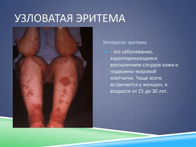 Erythema nodosum as Leprosy reaction - Semenova - Vestnik dermatologii i  venerologii