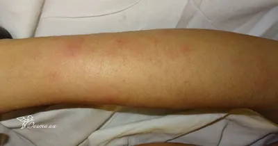 Erythema nodosum as Leprosy reaction - Semenova - Vestnik dermatologii i  venerologii