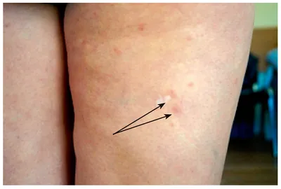 Erythema nodosum as Leprosy reaction - Semenova - Vestnik dermatologii i  venerologii