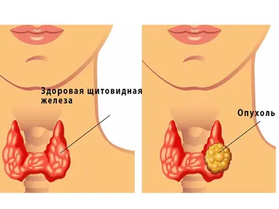 Узловой зоб фото