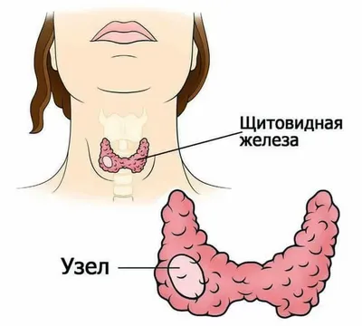 Узловой нетоксический зоб - причины появления, симптомы заболевания,  диагностика и способы лечения