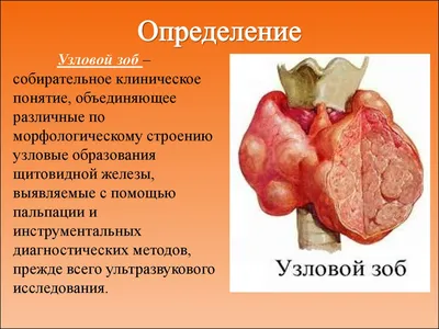 Медицинский центр Бишкек on Instagram: \"❗️Узловой зоб – это собирательное  понятие, которое характеризует особую структуру щитовидной железы с  наличием одного или нескольких узловых новообразований. ♦️Узловой зоб  характеризуется разрастанием ...