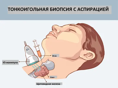 Узловой нетоксический зоб - причины появления, симптомы заболевания,  диагностика и способы лечения