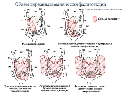 Узловой зоб - презентация онлайн