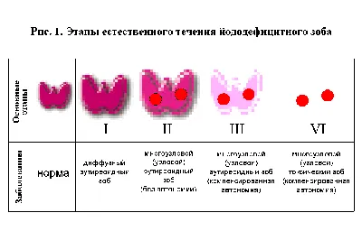 Лечение узлового зоба в Житомире - медицинский центр Оксфорд Медикал