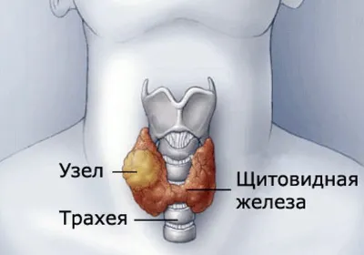 Удаление узлов щитовидной железы