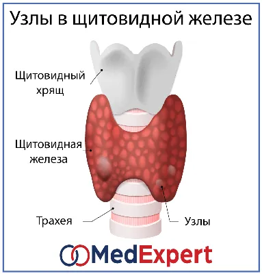 Узлы на щитовидке фото