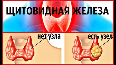 Могут ли узлы в щитовидной железе превратиться в рак? На частый вопрос от  наших пациентов «Могут ли узлы в.. | ВКонтакте