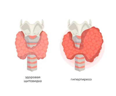 Может ли рассосаться узел в щитовидке? | Чара. Упражнения для женщин.  Женское здоровье, молодость и красота! | Дзен