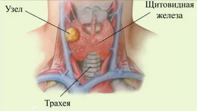 Узлы в щитовидке: надо ли их бояться - Рамблер/новости