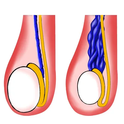 Варикоцеле. Способы лечения. Операция варикоцеле - цена в СПб