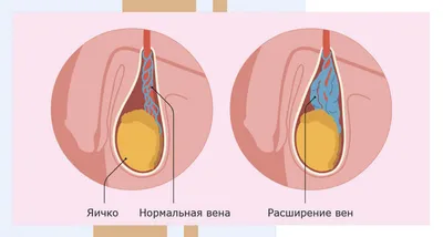 Варикоцеле: причины, симптомы и лечение в Клинике АльтраВита