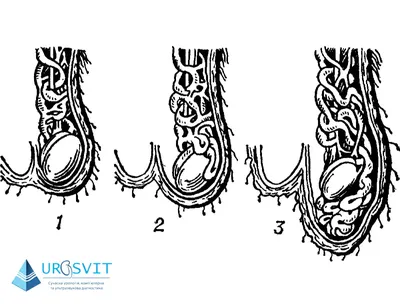Варикоцеле: симптомы, причины, лечение, последствия, признаки и последствия  заболевания