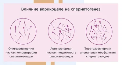 Варикоцеле - одна из причин бесплодия у мужчин