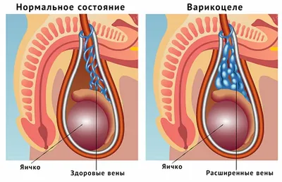 Сравнительная оценка различных хирургических методов лечения варикоцеле при  патоспермии – тема научной статьи по клинической медицине читайте бесплатно  текст научно-исследовательской работы в электронной библиотеке КиберЛенинка