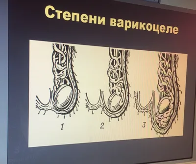 Лечение варикоцеле: фото до и после операции, отзывы наших пациентов