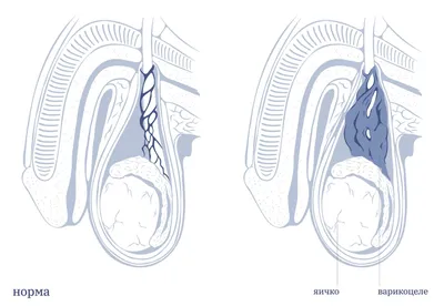 Варикоцеле - что это? Причины, признаки, профилактика врикоцеле у мужчин