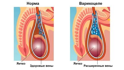 Варикоцеле: причины, симптомы и лечение в Клинике АльтраВита