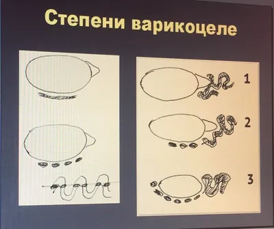 МОСКВА - СТОЛИЦА ЗДОРОВЬЯ\". ВАРИКОЦЕЛЕ У ДЕТЕЙ: КОГДА НУЖНА ОПЕРАЦИЯ |  ДГКБ-9