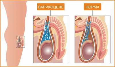 Варикоцеле у мужчин: лечение, степени, симптомы и причины