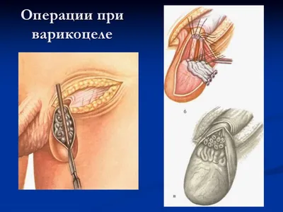 Варикоцеле у детей